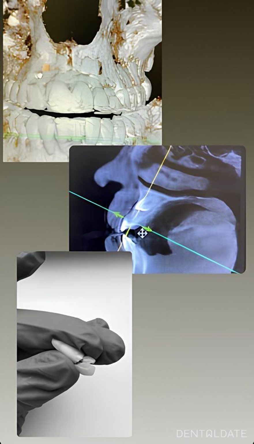Atraumatic canines tooth extraction | DentalDate Dentistry Cases