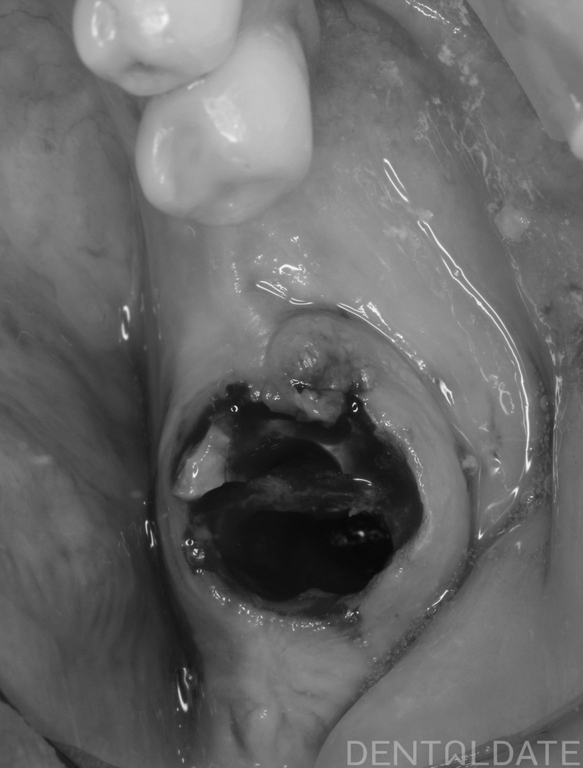 Atraumatic Tooth Extraction Prior to Implant Placement: Preservation of ...