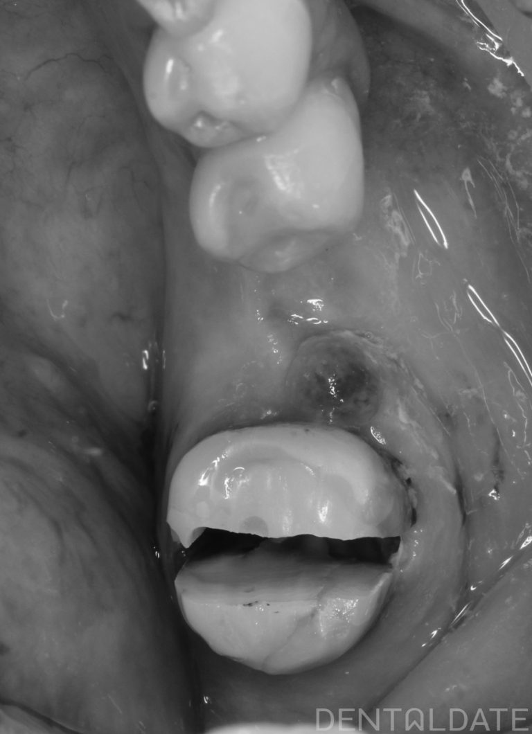 Atraumatic Tooth Extraction Prior to Implant Placement: Preservation of ...