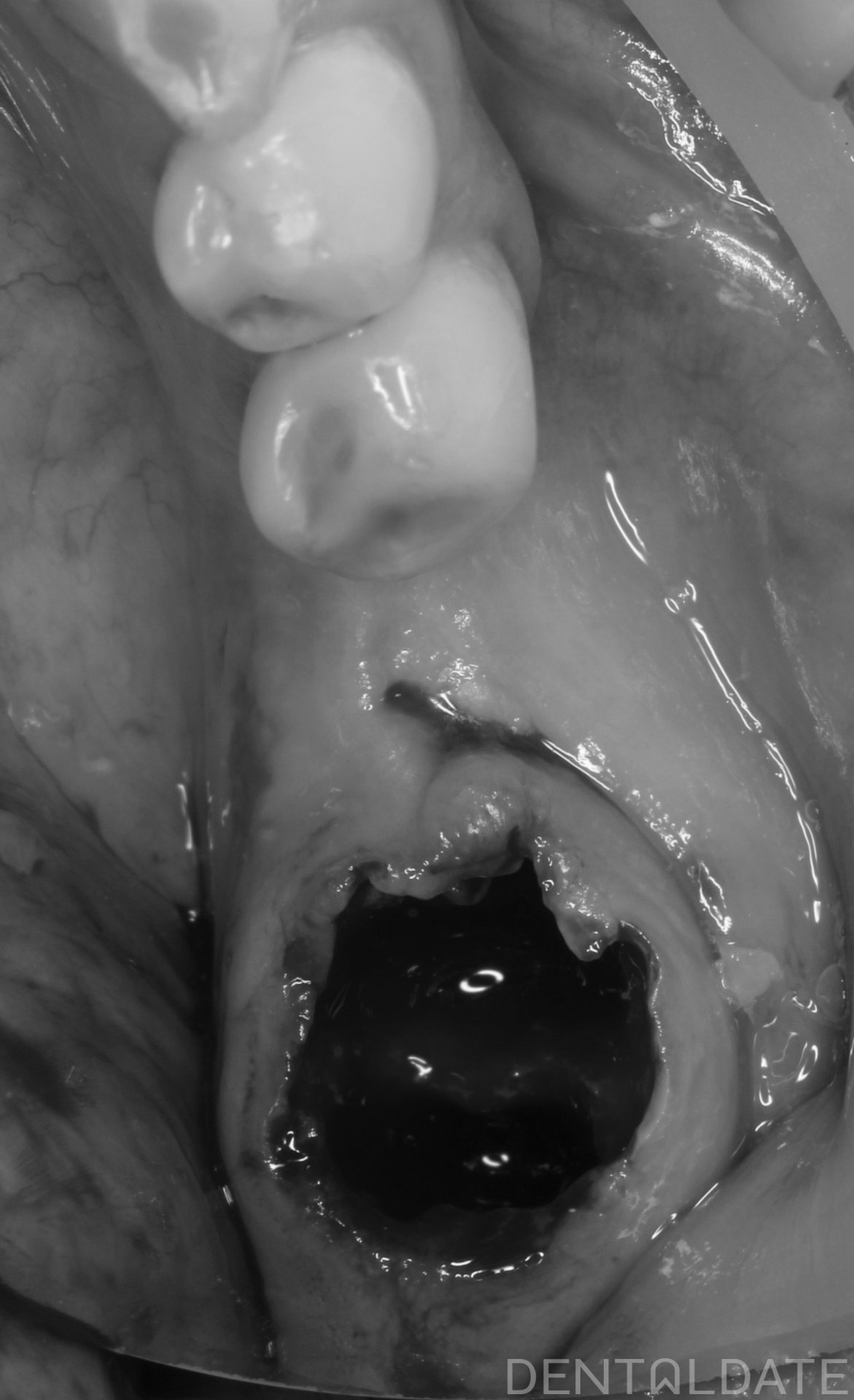 Atraumatic Tooth Extraction Prior to Implant Placement: Preservation of ...