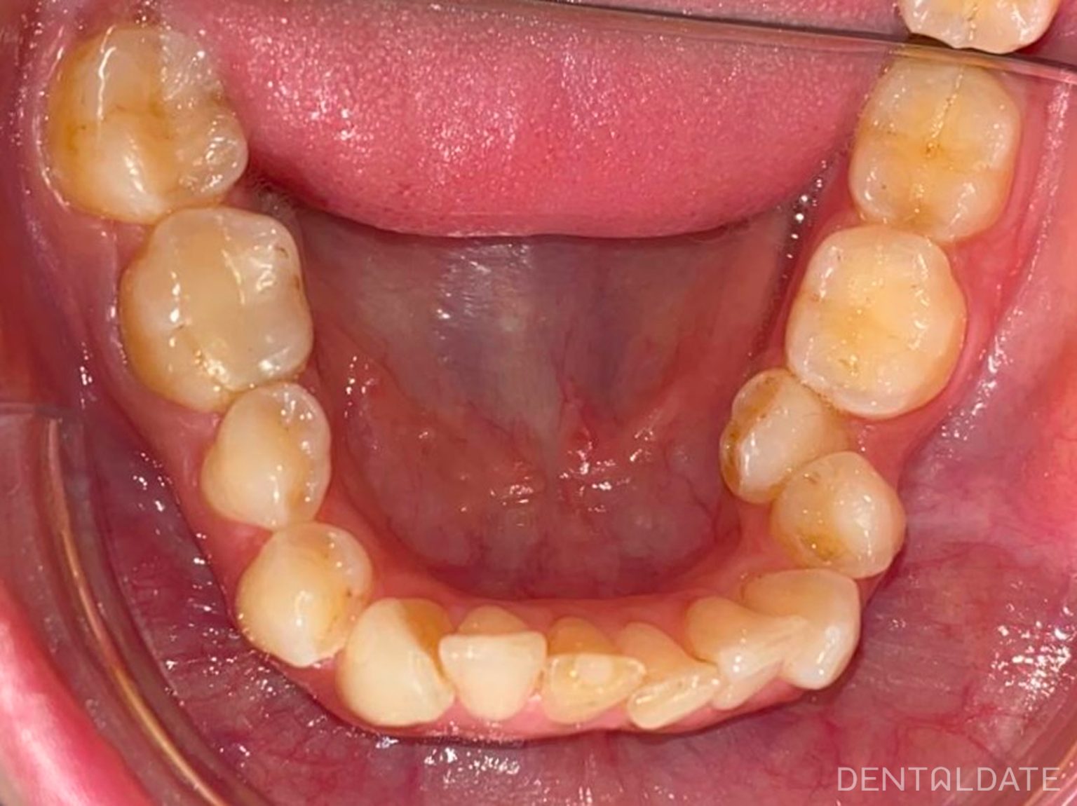 Orthodontic treatment with correction of occlusion and alignment of ...